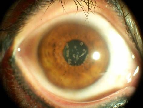 格子状角膜营养不良的病因与早早期症状