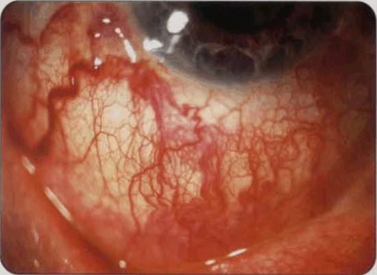 什么是干眼症及干眼症的症状