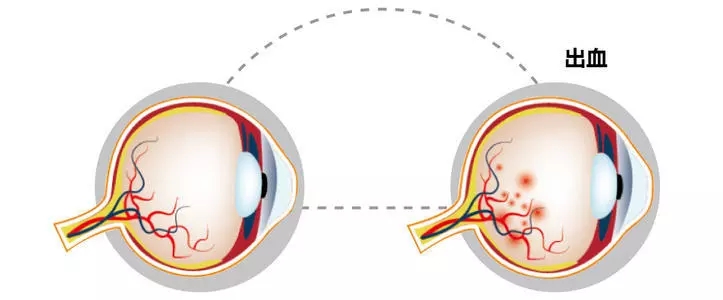 眼底出血是什么原因会引起的如何治疗